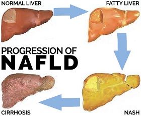 Fatty Liver Questions Answered