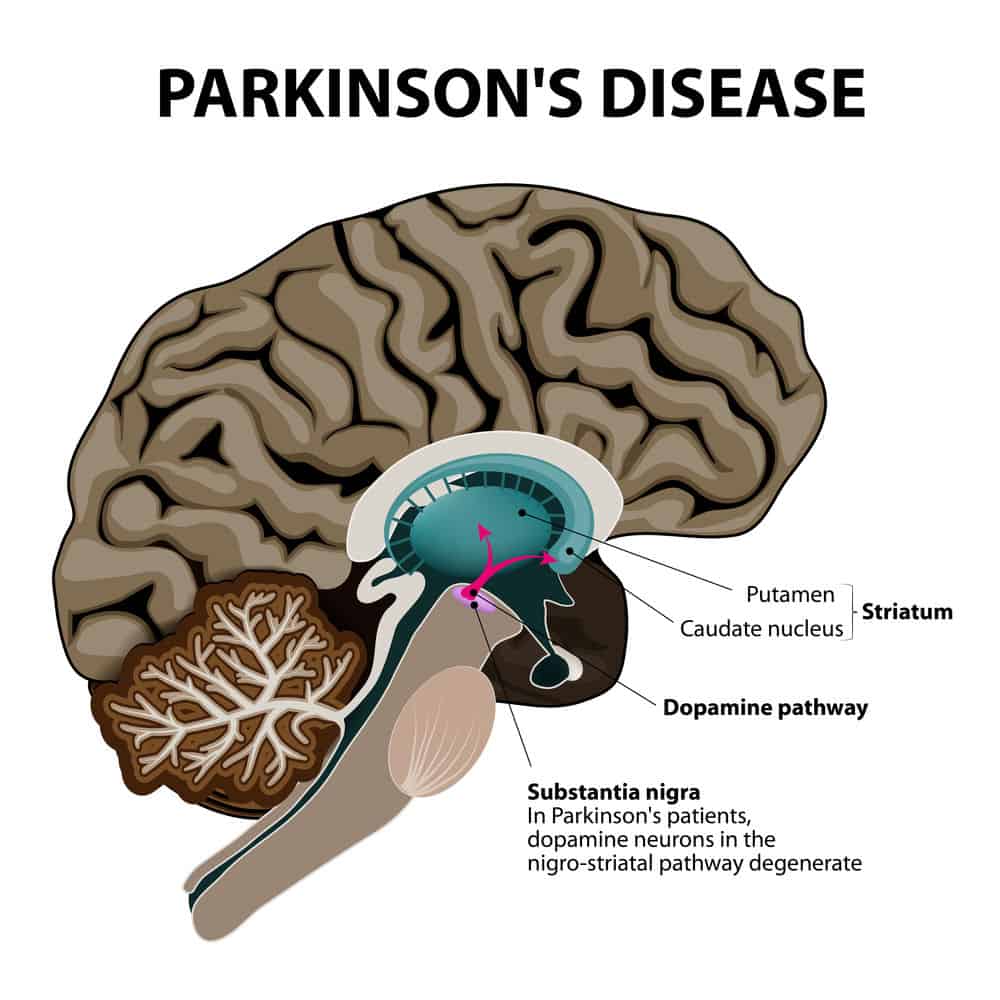 did-you-know-the-link-between-hcv-and-parkinson-s-disease