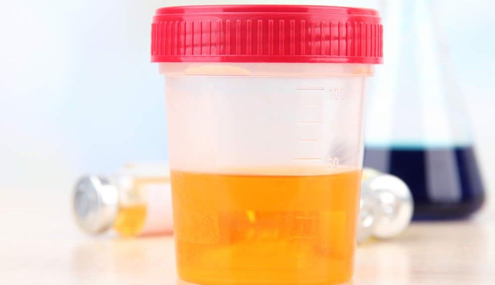 Dark Orange Amber Or Brown Urine Could Indicate A Liver Problem