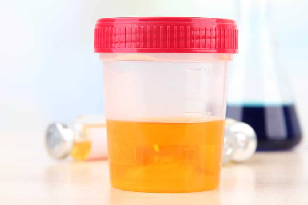 Dark Urine Could Indicate A Liver Problem