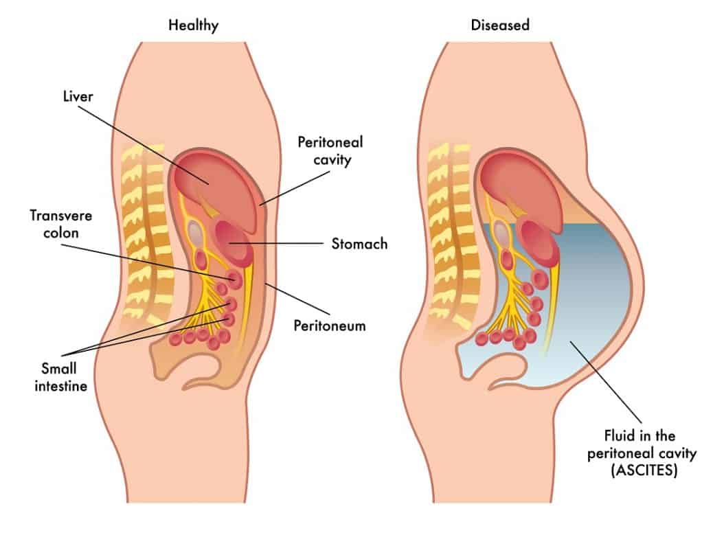 What Is Ascites 