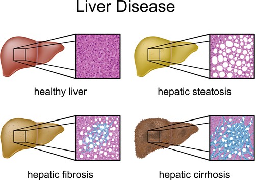 One Step Closer to Finding Fatty Liver Medication - LiverSupport.com