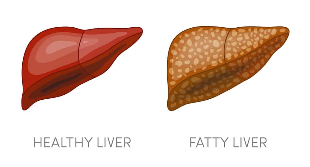 one-step-closer-to-finding-fatty-liver-medication-liversupport