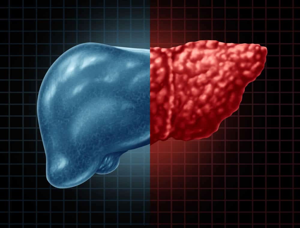 reverse-fatty-liver-new-drug-discovered-i-liversupport