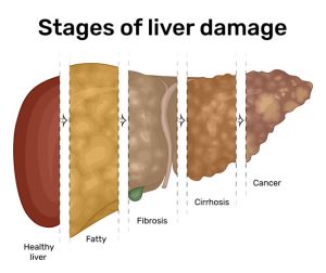 Liver Issues Caused by Liver Scar Tissue | LiverSupport.com