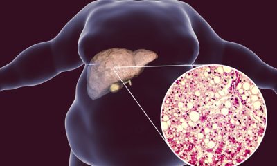 Denifanstat May Expand Treatment Options for People with Fatty Liver Disease