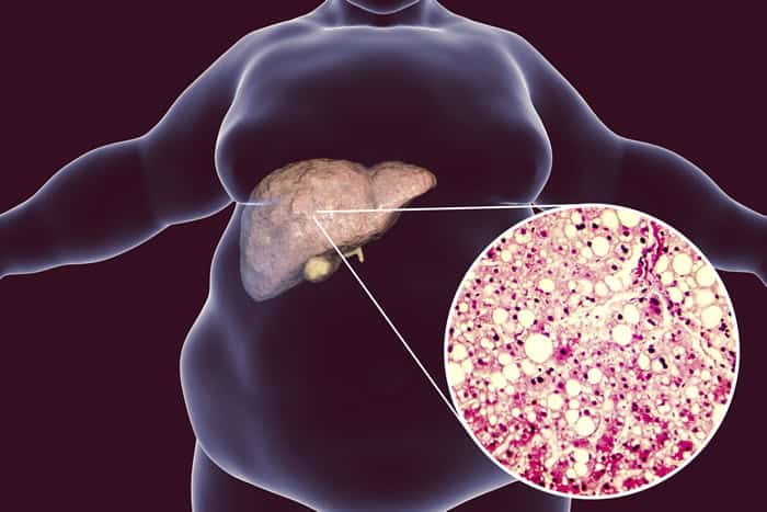 Denifanstat May Expand Treatment Options for People with Fatty Liver Disease